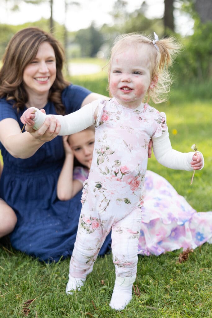 A little girl with Epidermolysis Bullosa (EB), a rare genetic disorder stands with her mother in the park.